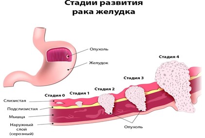 Рак желудка и печени